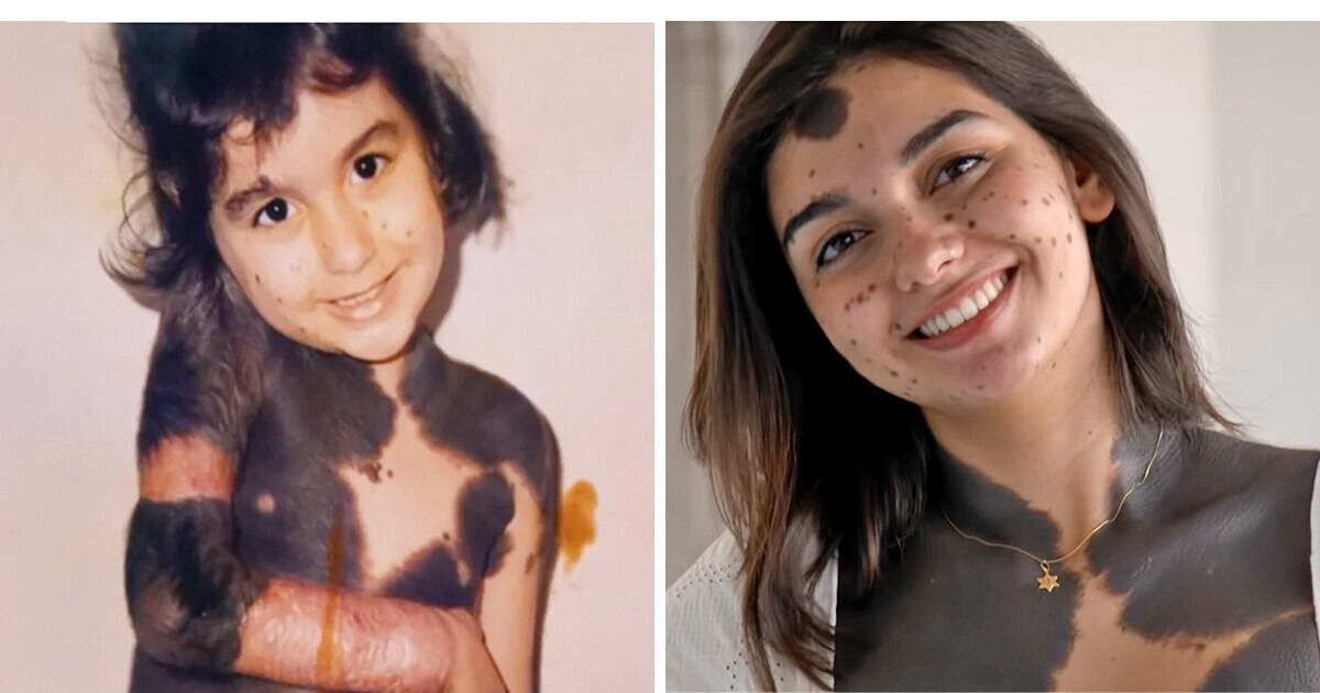 Nazywano mnie „małpą” z powodu mojego znamienia, ale odpuściłam operacje i znalazłam miłość