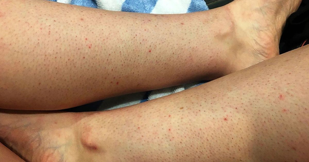 Co powoduje truskawkowe nogi i jak ich uniknąć Co powoduje truskawkowe nogi i jak ich uniknąć