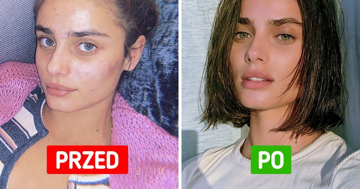 6 naturalnych sposobów na pozbycie się pryszczy