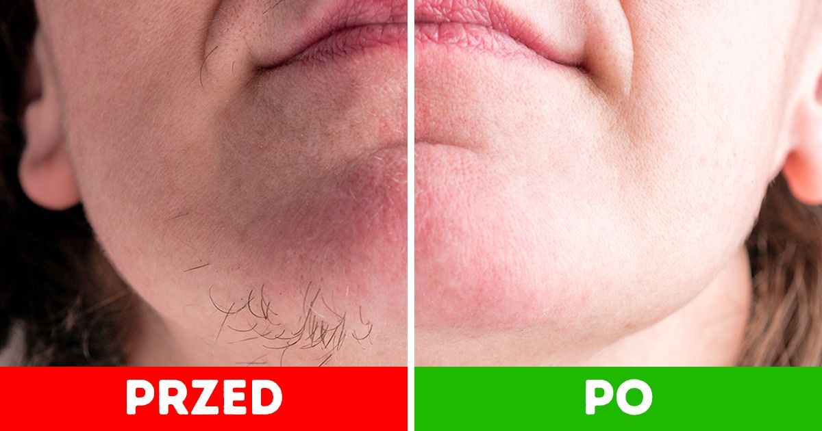 9 domowych sposobów, żeby pozbyć się owłosienia na twarzy 9 domowych sposobów, żeby pozbyć się owłosienia na twarzy