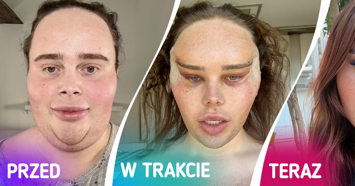 Influencerka pokazuje szokujące efekty operacji plastycznej „lisiego oka” Influencerka pokazuje szokujące efekty operacji plastycznej „lisiego oka”
