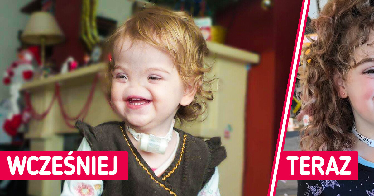 Dziewczynka urodzona bez nosa z dumą nosi przezwisko „Voldemort” i akceptuje swoją odmienność Dziewczynka urodzona bez nosa z dumą nosi przezwisko „Voldemort” i akceptuje swoją odmienność