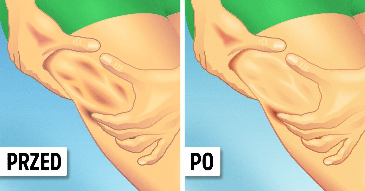 Dermatolodzy zdradzają sposoby na zmniejszenie cellulitu, które naprawdę działają