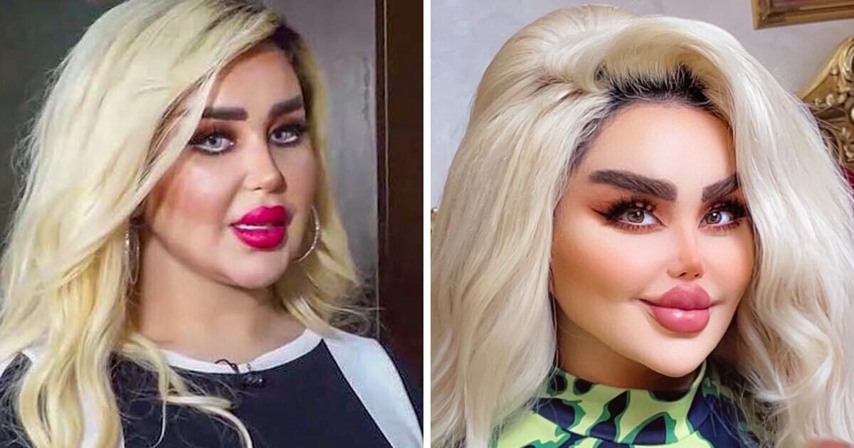 Poddała się 43 zabiegom, żeby upodobnić się do Barbie. Usłyszała, że wygląda jak „zombie”