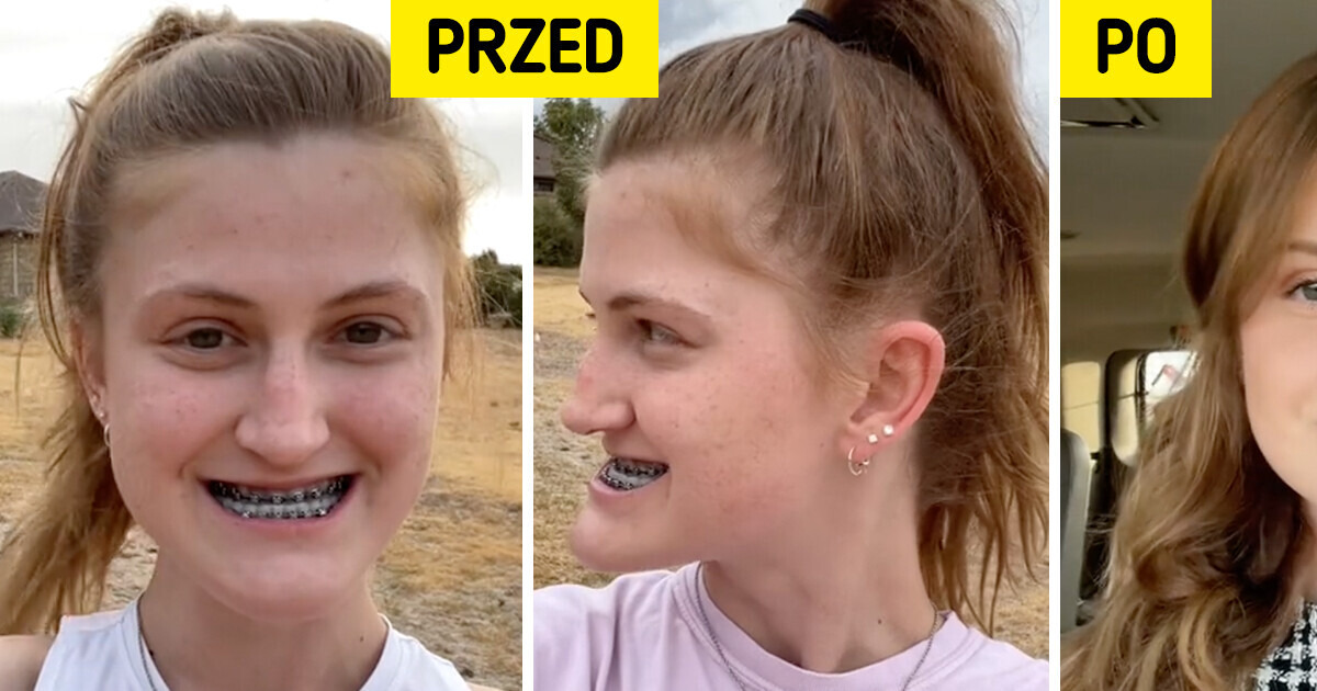Młoda kobieta opisuje swoją operację szczęki i zaskakuje efektami Młoda kobieta opisuje swoją operację szczęki i zaskakuje efektami