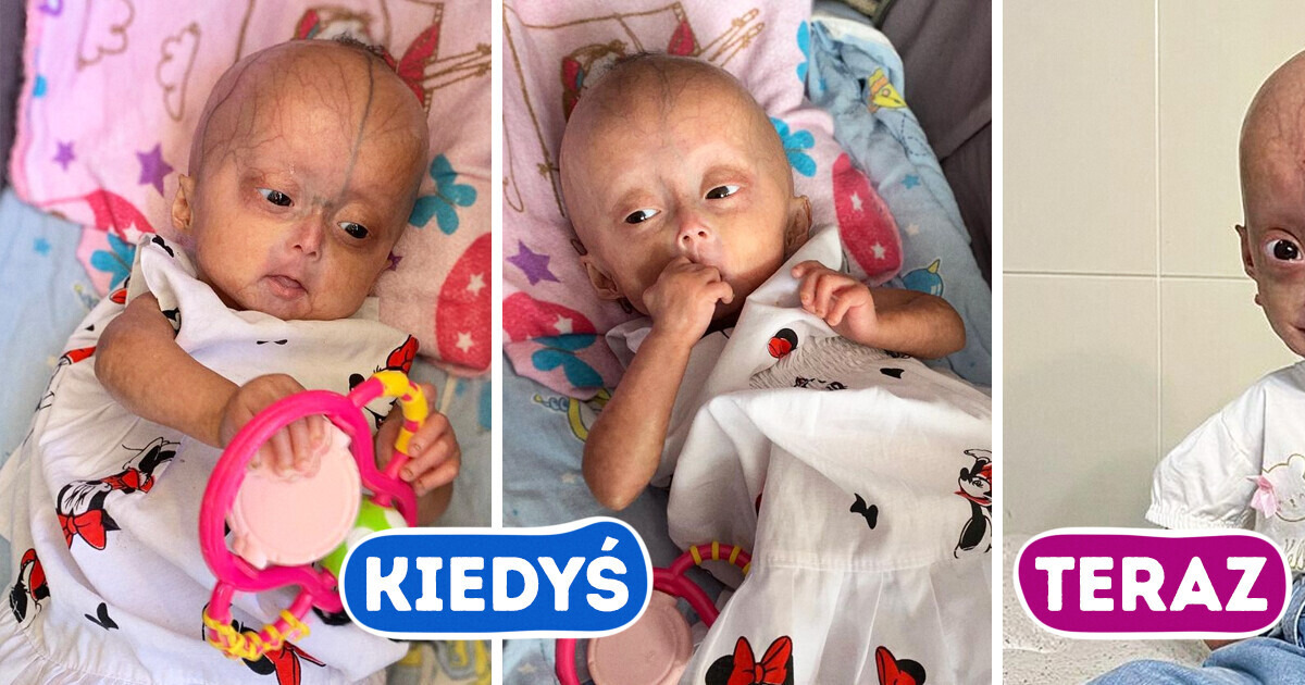 Poznajcie bliźnięta z rzadką „chorobą Benjamina Buttona” Poznajcie bliźnięta z rzadką „chorobą Benjamina Buttona”