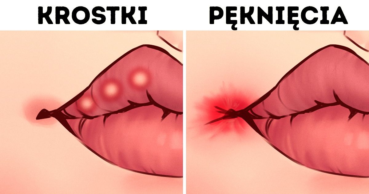 Co zmiany na ustach mówią o twoim zdrowiu