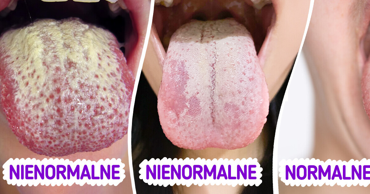 Co biały język mówi o twoim zdrowiu i jak go naturalnie wyleczyć Co biały język mówi o twoim zdrowiu i jak go naturalnie wyleczyć