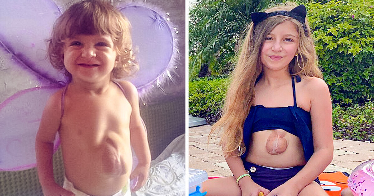 Poznajcie niesamowitą dziewczynkę, która urodziła się z sercem bijącym poza klatką piersiową