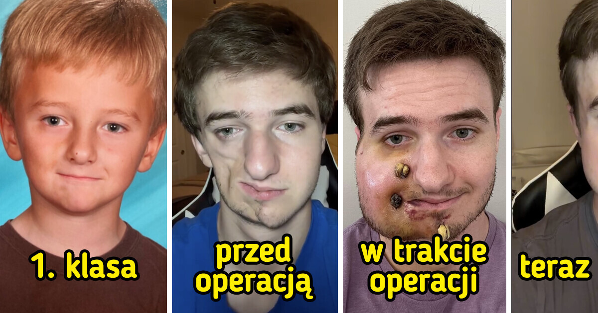 Oto Lukas: prawdziwa historia zespołu Parry’ego-Romberga i obecny wygląd chorego Oto Lukas: prawdziwa historia zespołu Parry’ego-Romberga i obecny wygląd chorego