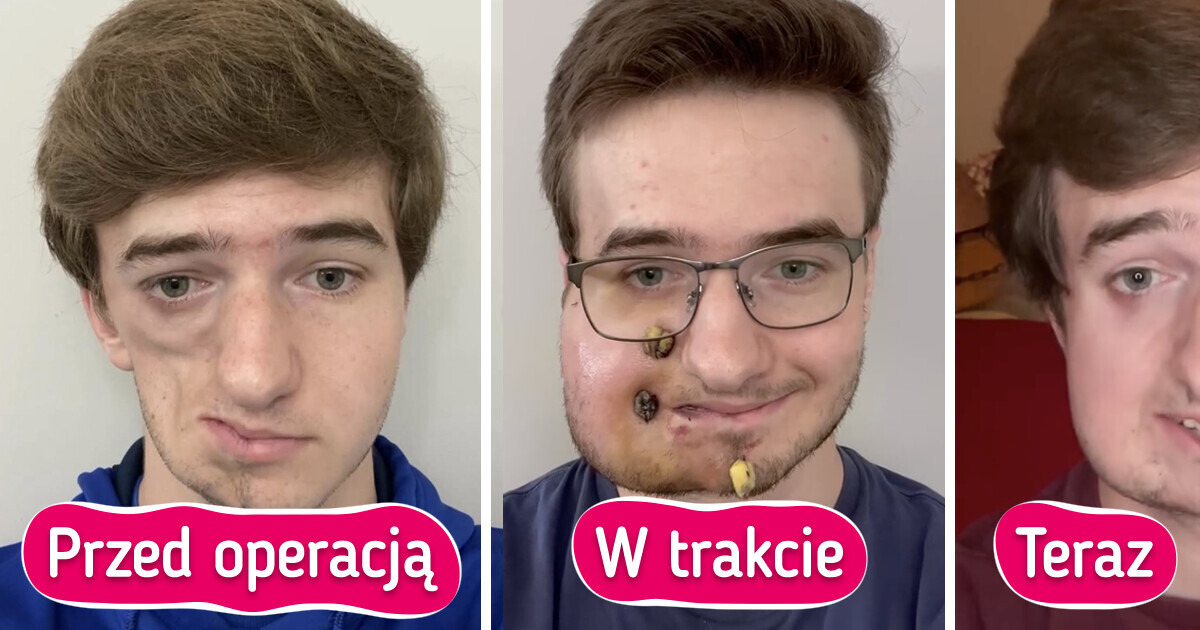Mężczyzna z zespołem Parry'ego-Romberga ujawnia, jak wygląda dzisiaj Mężczyzna z zespołem Parry'ego-Romberga ujawnia, jak wygląda dzisiaj