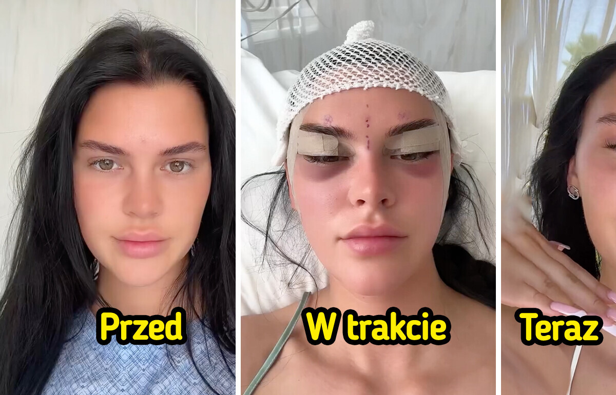 Młoda kobieta dokumentuje swoją operację „lisich oczu” i szokuje efektami