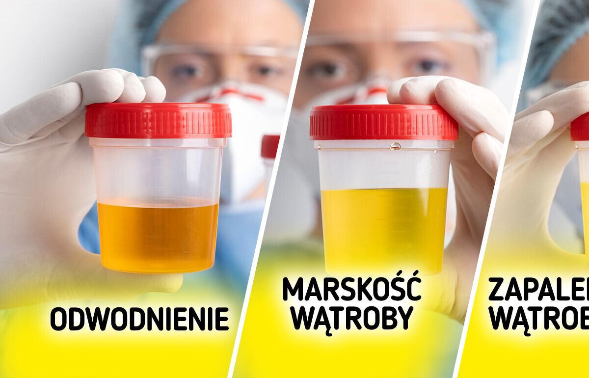 7 nietypowych kolorów moczu, których nie należy ignorować