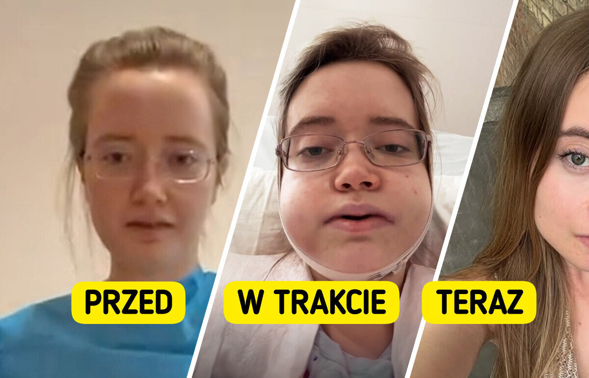 24-latka zdecydowała się na ryzykowny zabieg. Efekt przerósł jej najśmielsze oczekiwania