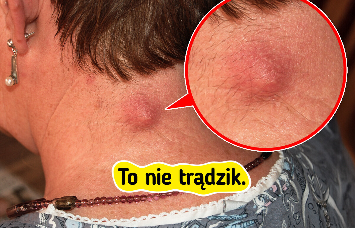 7 zmian skórnych innych niż trądzik, które warto znać
