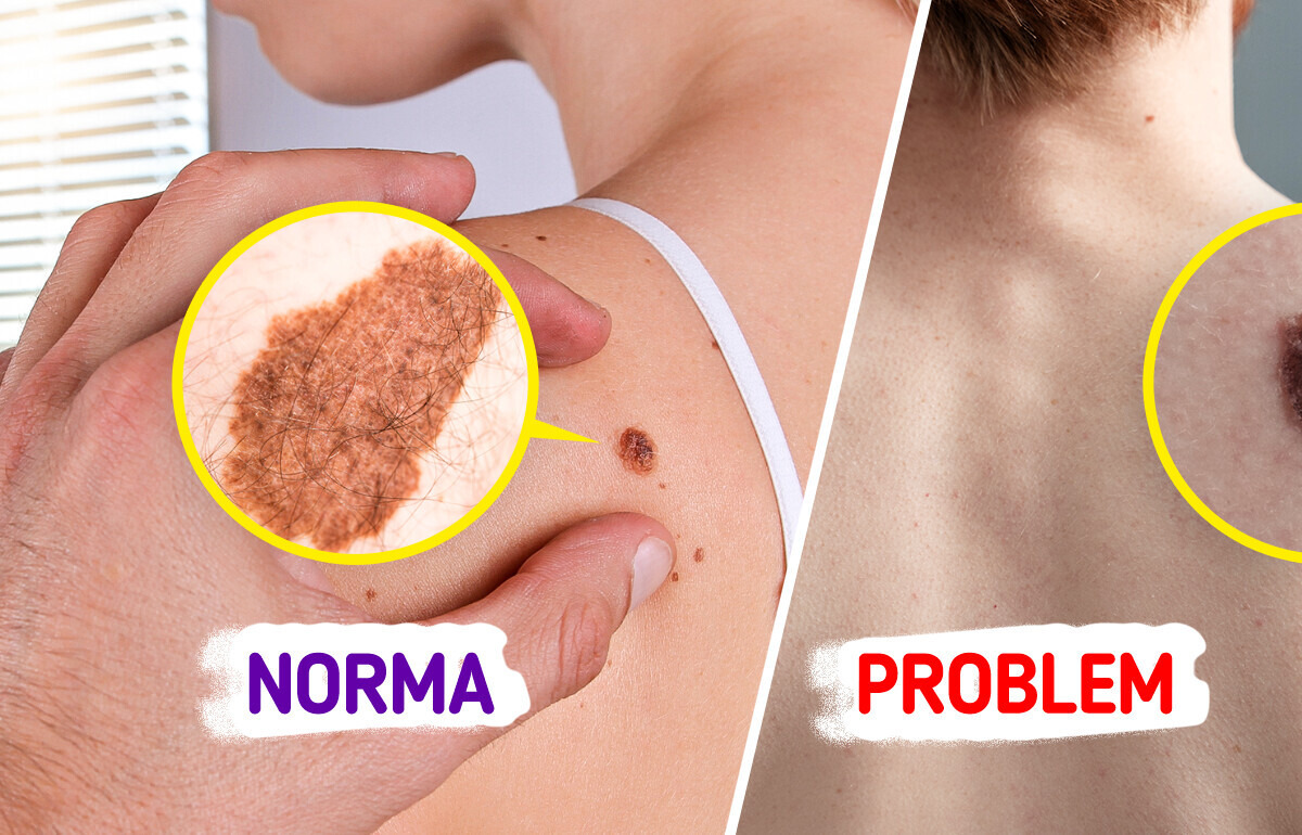 5 oznak, że twoje pieprzyki mogą być rakiem skóry