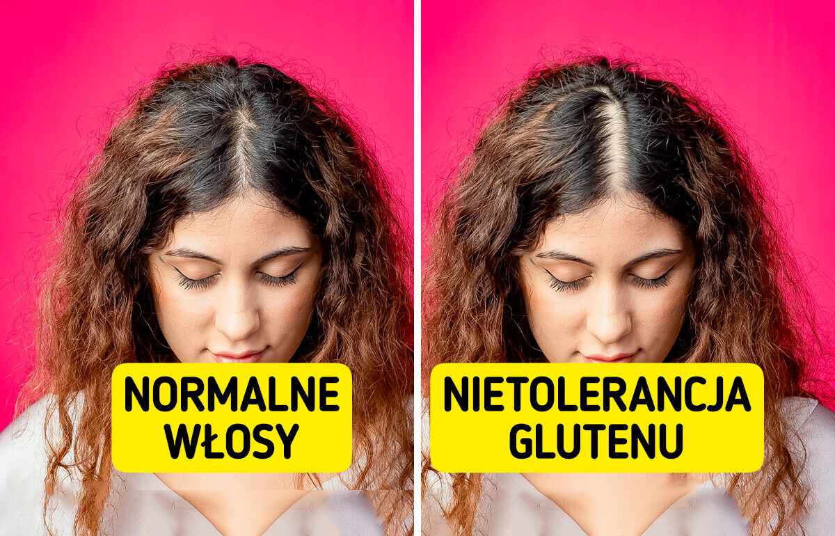 13 nietypowych reakcji organizmu na gluten 13 nietypowych reakcji organizmu na gluten
