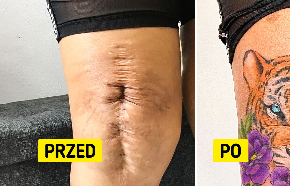 11 osób, które wymyśliły sposób, żeby z blizn zrobić dzieło sztuki 11 osób, które wymyśliły sposób, żeby z blizn zrobić dzieło sztuki