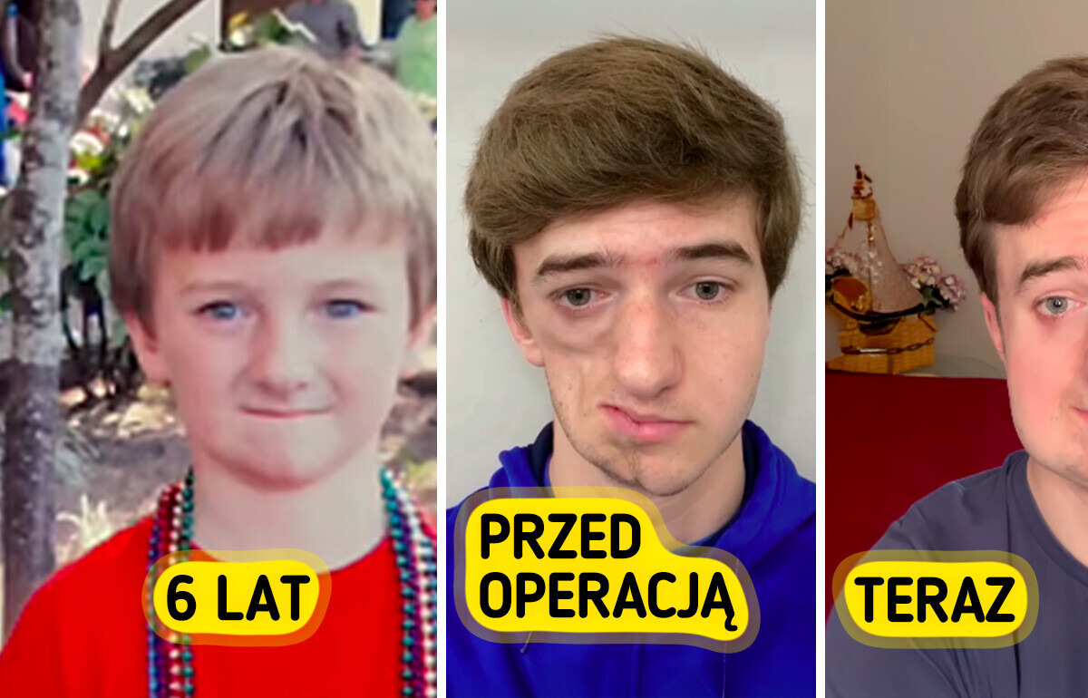 Rzadkie schorzenie młodego mężczyzny sprawiło, że został internetowym bohaterem