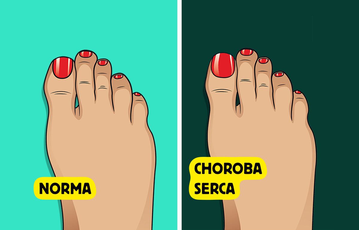 5 oznak choroby, które widać na paznokciach u nóg