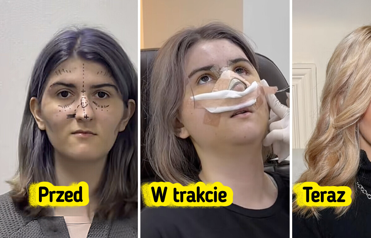 Kobieta ujawnia drastyczną przemianę po operacji plastycznej w Korei Południowej