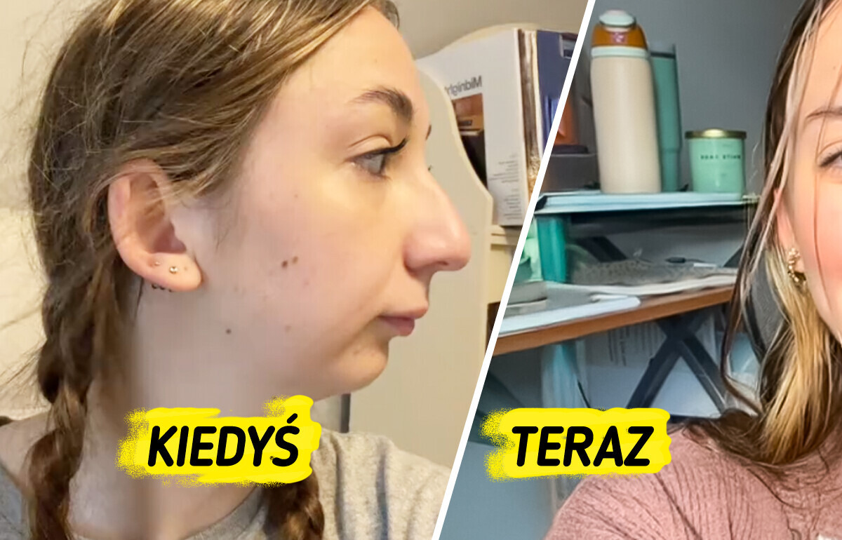 Spektakularna zmiana po operacji szczęki — młoda kobieta podbija internet