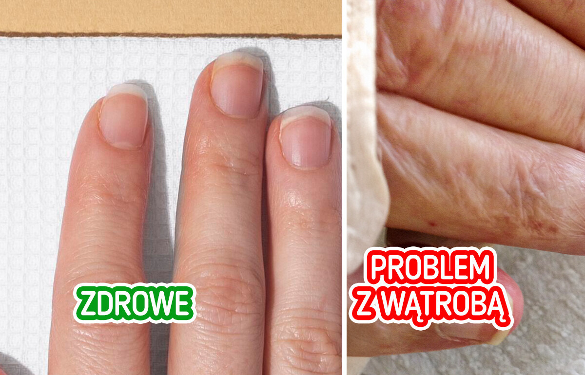 6 nietypowych objawów, które mogą świadczyć o problemach z wątrobą