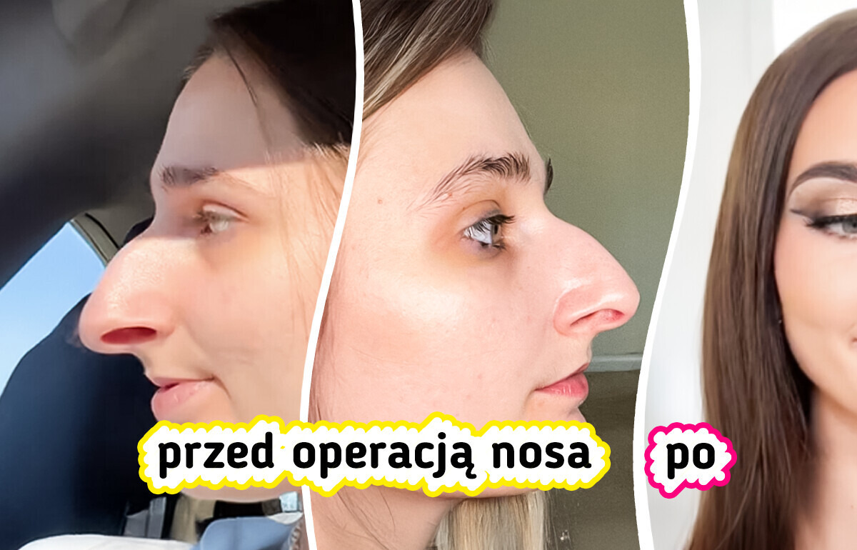 Kobieta oszczędzała przez dekadę na operację nosa — efekty dzielą internet Kobieta oszczędzała przez dekadę na operację nosa — efekty dzielą internet