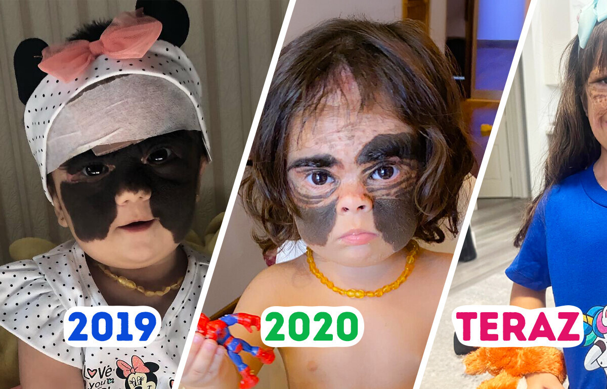 Dziewczynka ze znamieniem jak „maska Batmana” dorosła i jej mama ma wspaniałe wiadomości Dziewczynka ze znamieniem jak „maska Batmana” dorosła i jej mama ma wspaniałe wiadomości
