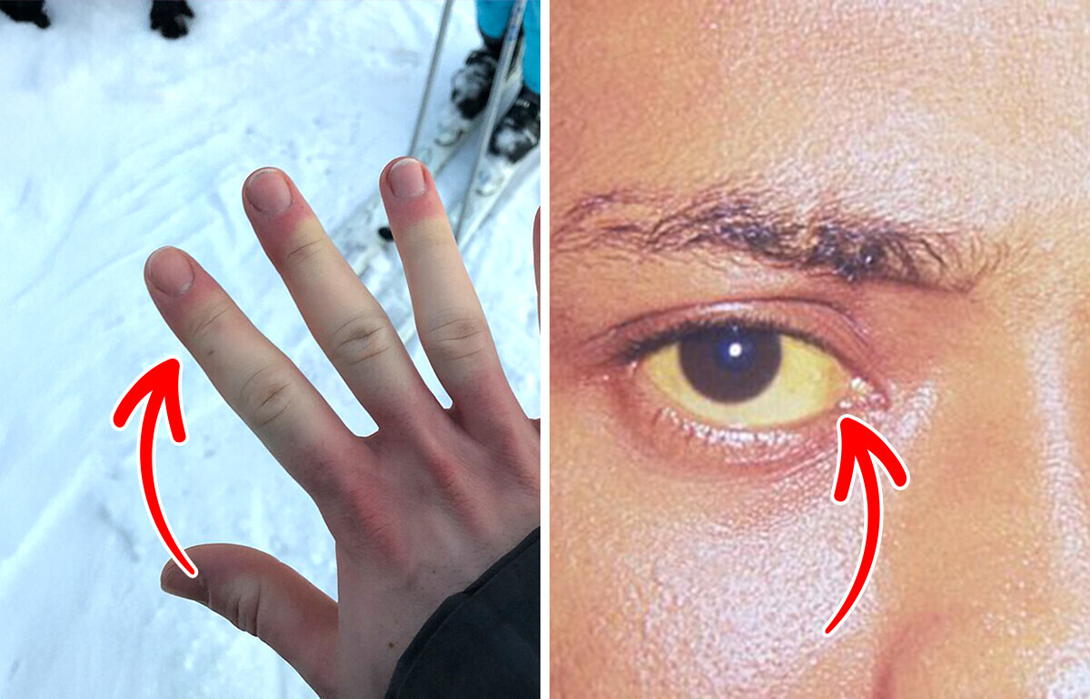 8 subtelnych objawów, że twój układ odpornościowy nie działa prawidłowo