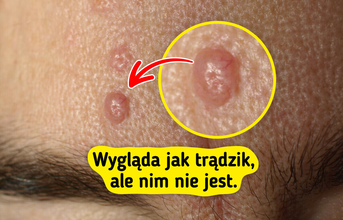 7 rodzajów krostek, które można pomylić z trądzikiem