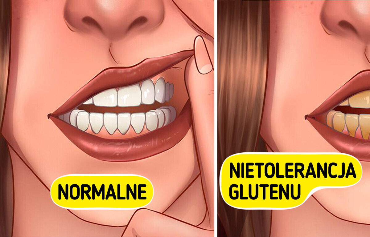 11 mniej znanych objawów nietolerancji glutenu