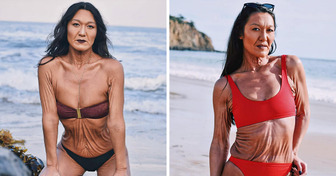 Poznajcie Sarę Geurts, 31-letnią modelkę z rzadką chorobą skóry. Zaakceptowała swoje zmarszczki i stała się inspiracją dla wielu osób