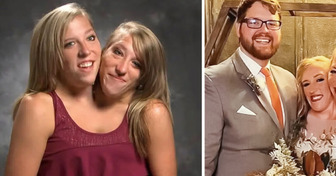 Jedna z syjamskich bliźniaczek wzięła ślub, co wywołało gorącą dyskusję w sieci