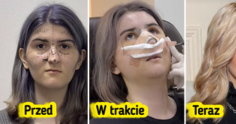 Kobieta ujawnia drastyczną przemianę po operacji plastycznej w Korei Południowej
