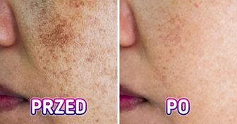 10 naturalnych sposobów na zmniejszenie przebarwień na twarzy