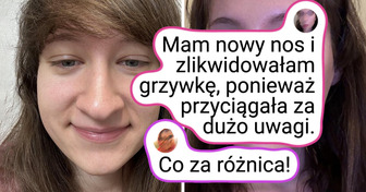 12 kobiet ujawniło, jak operacje plastyczne zmieniły ich twarze