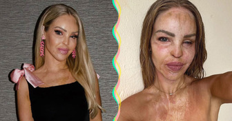 „Skończyło się” — dobre wieści od Katie Piper 16 lat po ataku kwasem