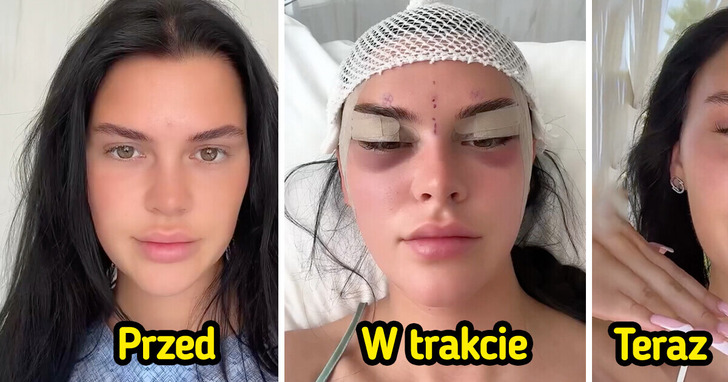 Młoda kobieta dokumentuje swoją operację „lisich oczu” i szokuje efektami