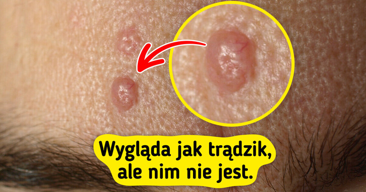7 rodzajów krostek, które można pomylić z trądzikiem