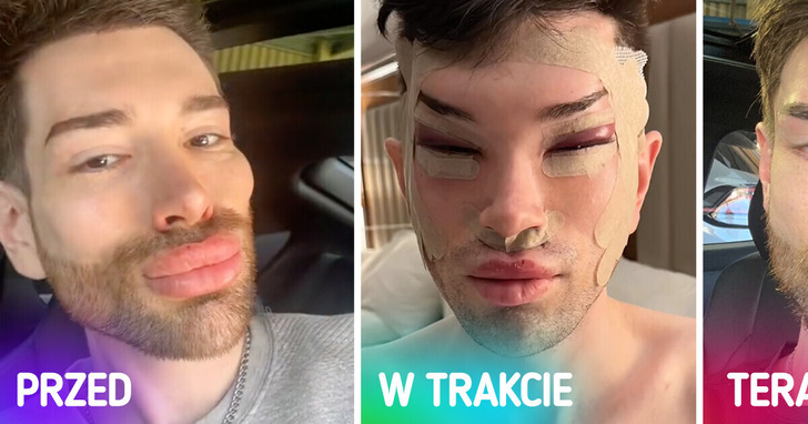 Mężczyzna pokazuje zaskakujące skutki operacji plastycznej oczu i usunięcia wypełniaczy twarzy