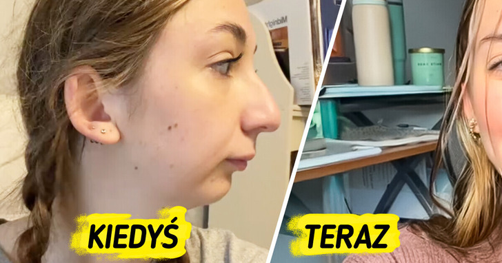 Spektakularna zmiana po operacji szczęki — młoda kobieta podbija internet