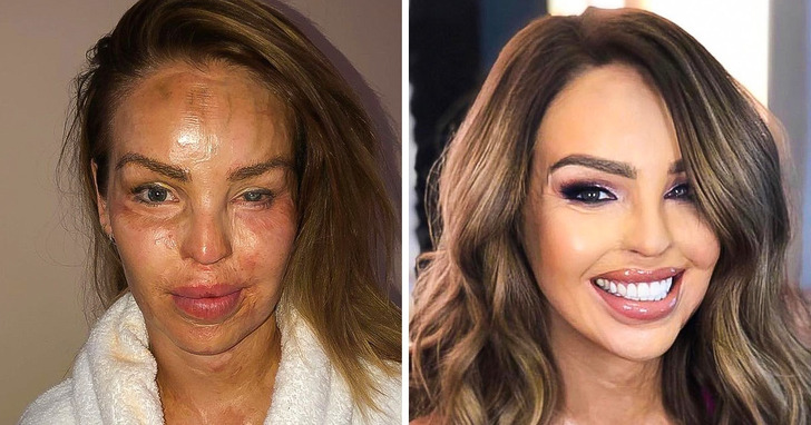 Katie Piper przeżyła atak kwasem swojego byłego partnera i odrodziła się niczym feniks z popiołów