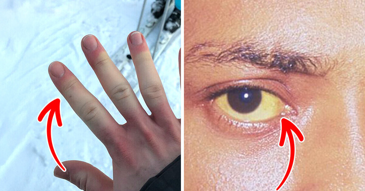 8 subtelnych objawów, iż twój układ odpornościowy nie działa prawidłowo