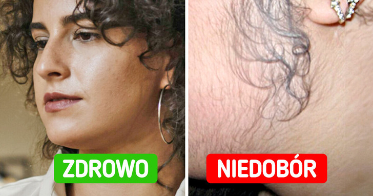 5 oznak, iż twoje ciało potrzebuje więcej witaminy D