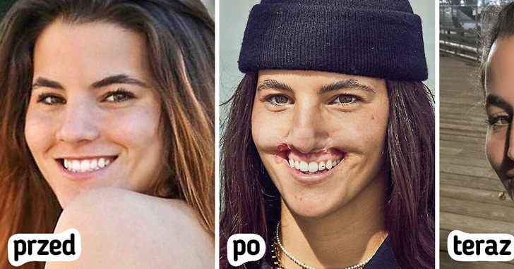 Modelka została okaleczona przez psa, ale z odwagą zaakceptowała swój nowy wygląd