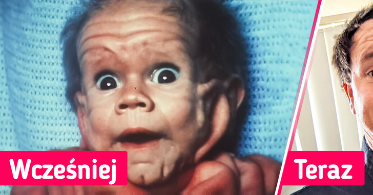 Dziecko urodziło się z rzadką chorobą skóry, która 20 lat temu zaskoczyła lekarzy