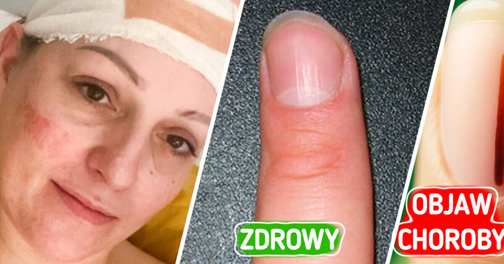 Kobieta zauważyła niewielką zmianę na paznokciu. niedługo usłyszała tragiczną diagnozę