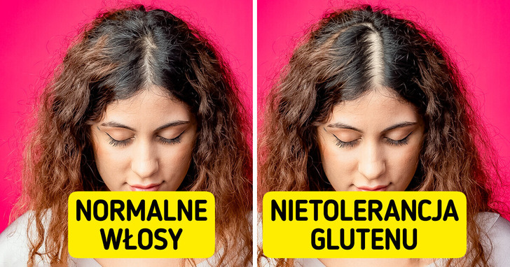 13 nietypowych reakcji organizmu na gluten