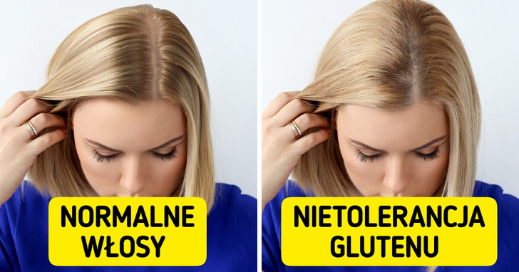 11 nietypowych oznak, iż możesz mieć nietolerancję glutenu